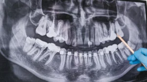 Your Guide to Wisdom Teeth Removal Say Goodbye to Tooth Troubles