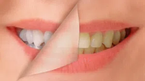 Stain Removal Hacks Say Goodbye to Yellow Teeth Forever!