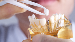 The Ultimate Guide to Dental Implants Restore Your Smile with Confidence