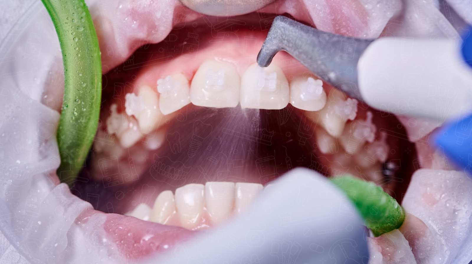 Why Professional Teeth Cleaning is Essential for a Healthy Smile