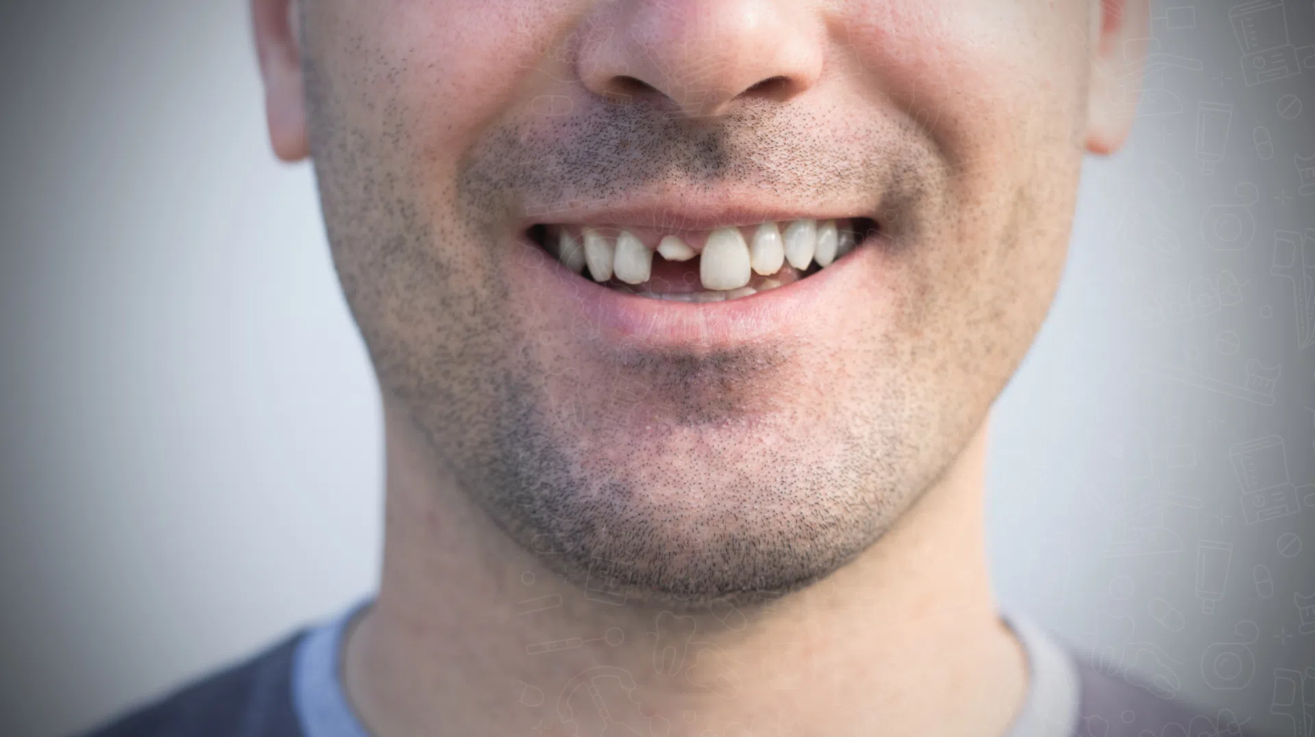 Cracked Tooth Repair with Dental Fillings: How Much Does It Cost?