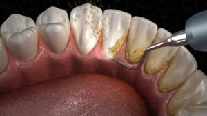 deep teeth cleaning