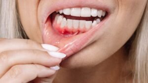 causes of bleeding gums