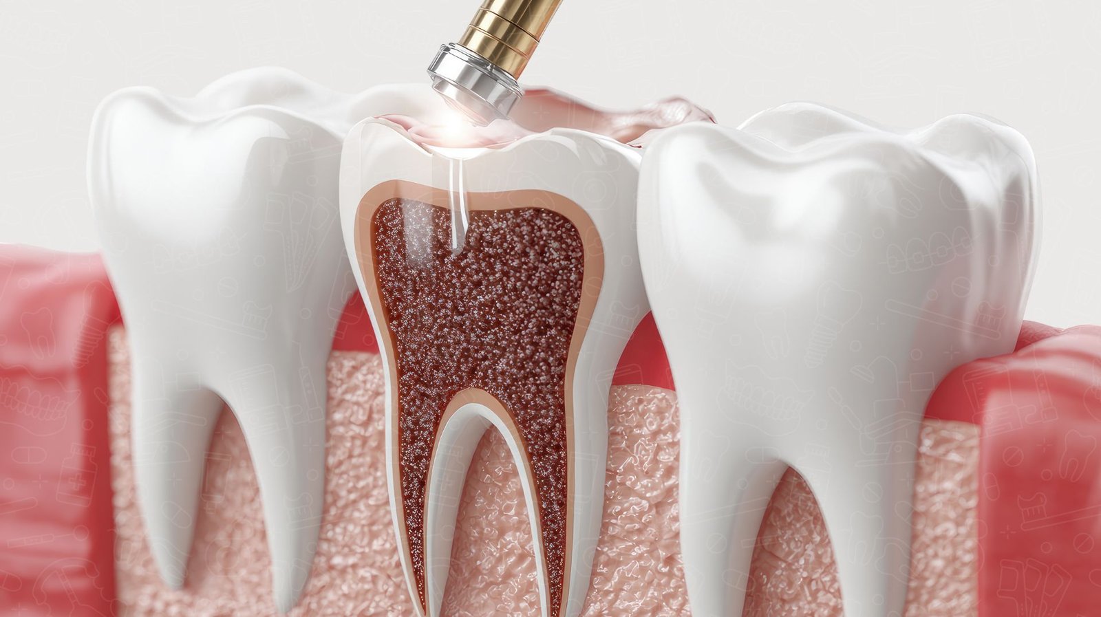 symptoms of needing a root canal